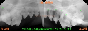 歯科レントゲン（3歳、歯周病）