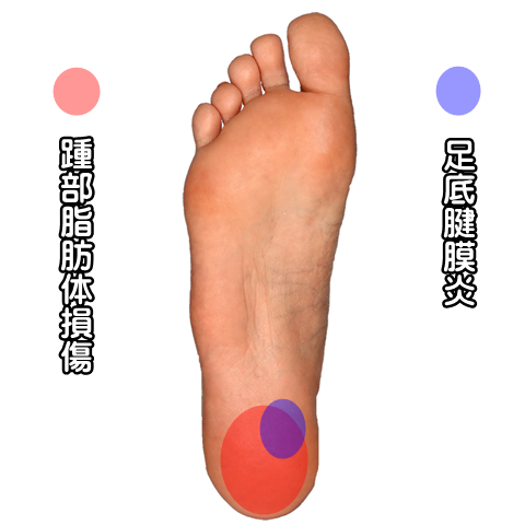 踵部脂肪体損傷,足底腱膜炎,京都市